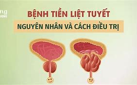 Hướng Dẫn Điều Trị Phì Đại Tiền Liệt Tuyến